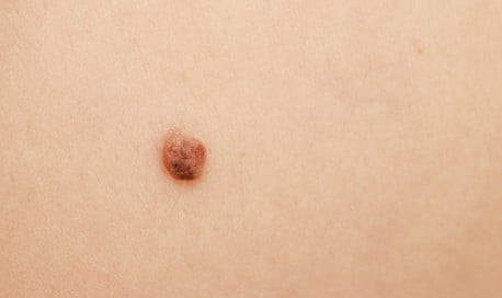 Cómo diferenciar un lunar normal de un melanoma y otros consejos de salud