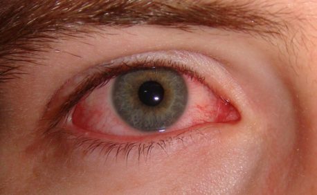 ¿Sabes por qué la marihuana te deja los ojos rojos? Acá está la respuesta