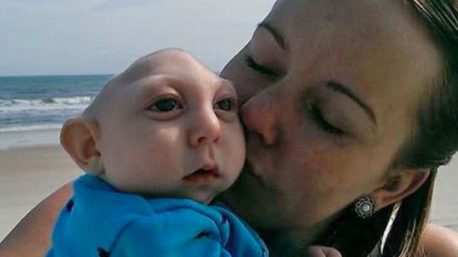 Jaxon el niño que nació con sólo medio cerebro ya tiene 2 años y este es su presente (+Fotos)