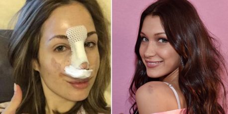 Esta chica ha pagado más de 12 mil euros en cirugías para parecerse a Bella Hadid (+Fotos)