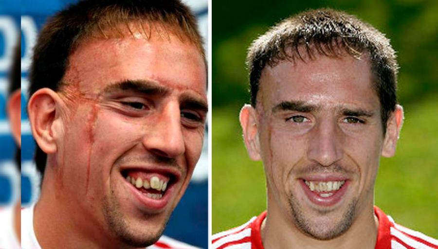 La Verdadera Historia Detrás De La Legendaria Cicatriz De Frank Ribery Que Ha Hecho Especular A