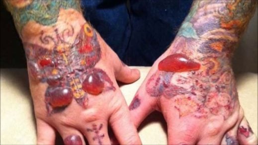 los tatuajes crean infecciones en la piel