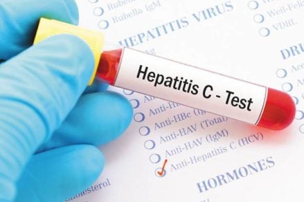 hepatitis