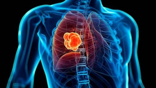 Descubren proteína que puede ayudar a curar el cáncer de pulmón