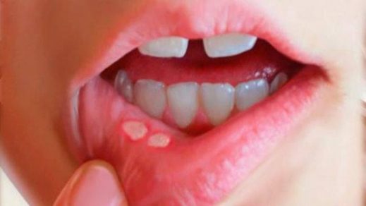 Las caries y otras enfermedades bucales hacen más vulnerable a la persona ante el covid-19