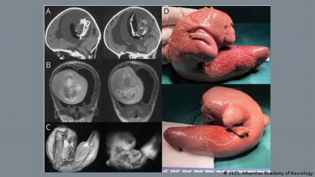 Científicos extraen del cerebro de una niña el feto de su hermano gemelo