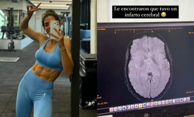 Influencer fitness sufre infarto cerebral tras inyectarse bótox